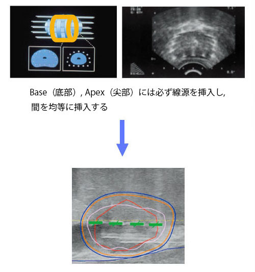 Peripheral Needles Placement_sp